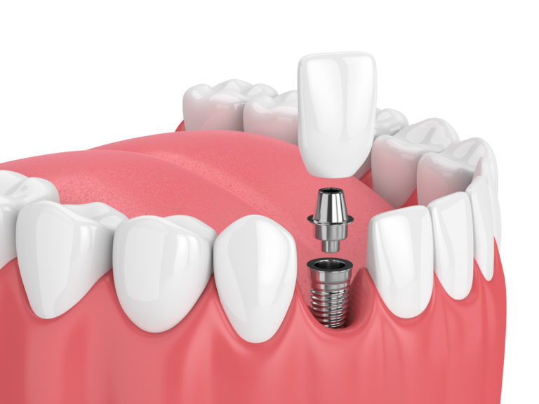 Illustration of a bottom row of teeth with a dental implant being inserted