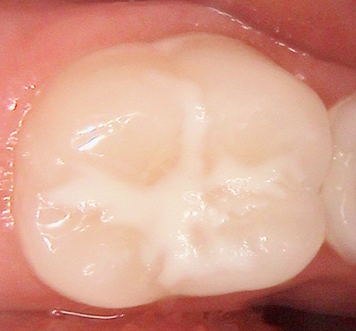 Upclose photo of a tooth filling