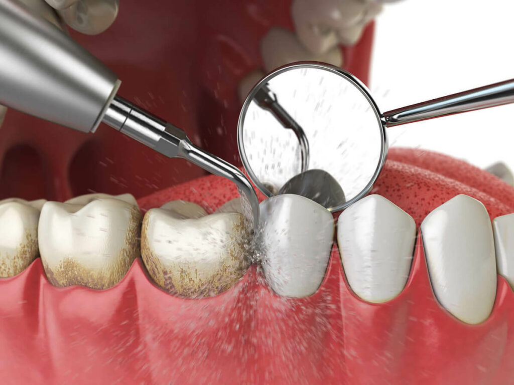 illustration of teeth being professionally cleaned
