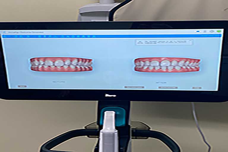 a 3d model of teeth displaying on the screen of an iTero digital scanner