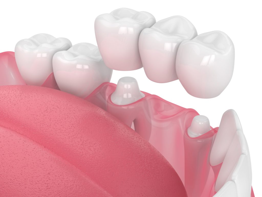 Dental Crowns and Bridges - Lakeview Family Dentists