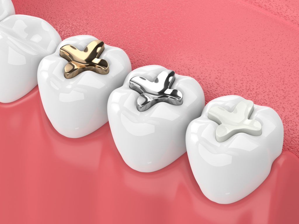Illustration of a bottom row of teeth with different types of fillings applied