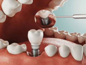 illustration of a dental implant being placed in the bottom row of teeth