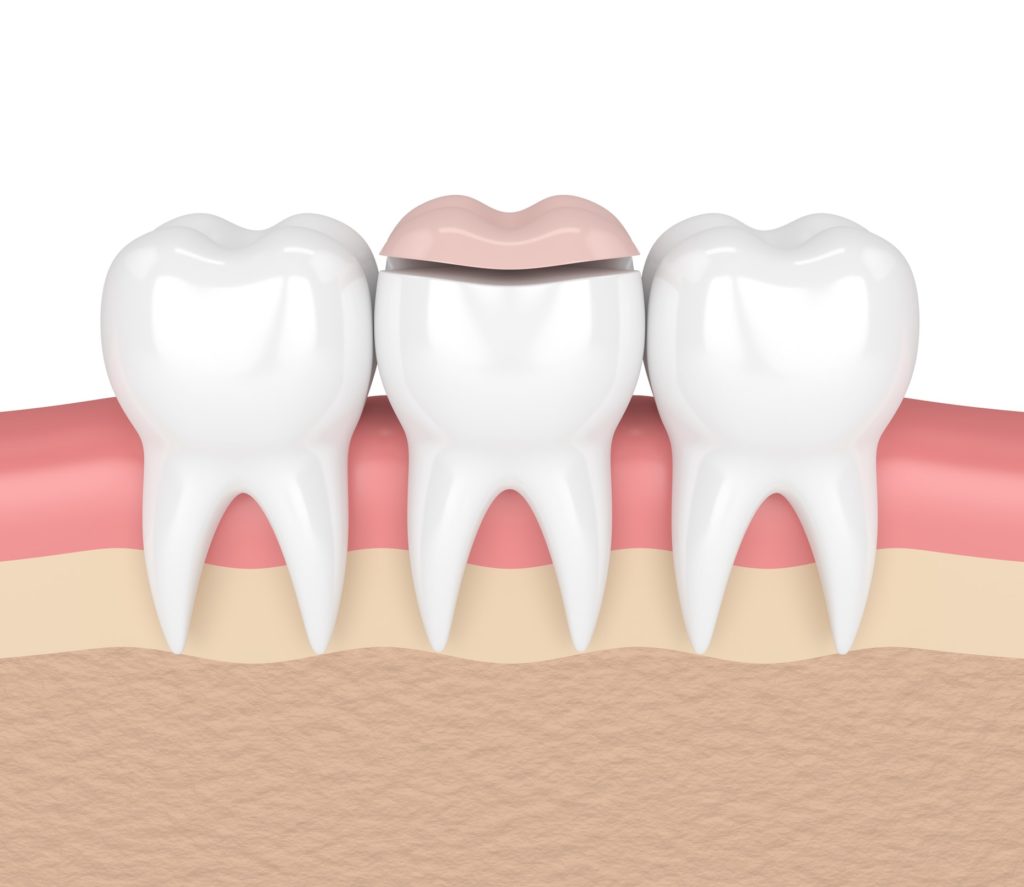 Illustration of three teeth in a row with a dental inlay applied to the middle tooth
