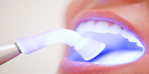 A dental laser shining into an open mouth