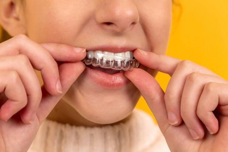 Invisalign FAQ