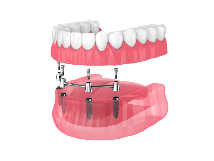 All-on-4 Dental Implants in Dracut, MA at Lakeview Family Dentists
