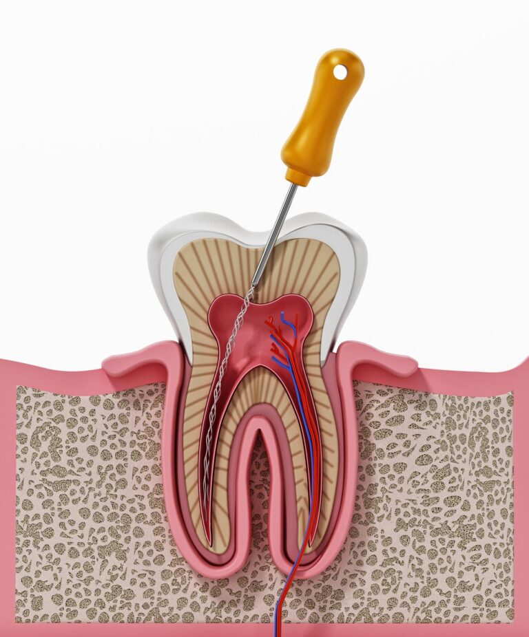 Illustration of a root canal procedure showing a cross-section of a tooth with a dental file cleaning infected pulp and nerve tissue inside the root canals.